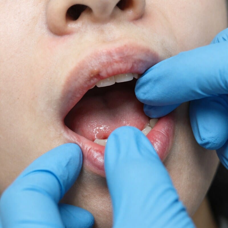 Oral medicine consultation at PerioHouse